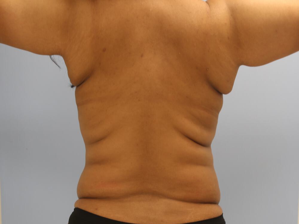 Back Lift (Bra Line Back Lift) Before and After Pictures Case 1099, Los  Angeles, CA